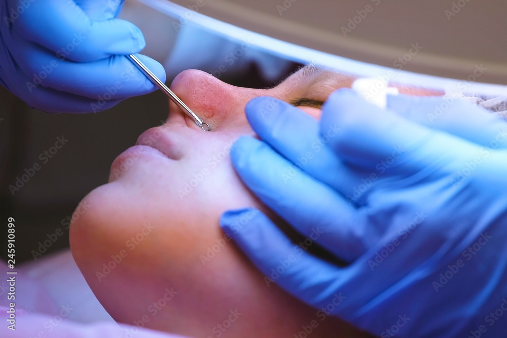 Mechanical cleaning of the face at the beautician. Cosmetologist squeeze the acne on the nose of the patient with medical needle. Mechanical cleaning of the face at the beautician. Cosmetologist squeeze the acne on the nose of the patient with medical needle.