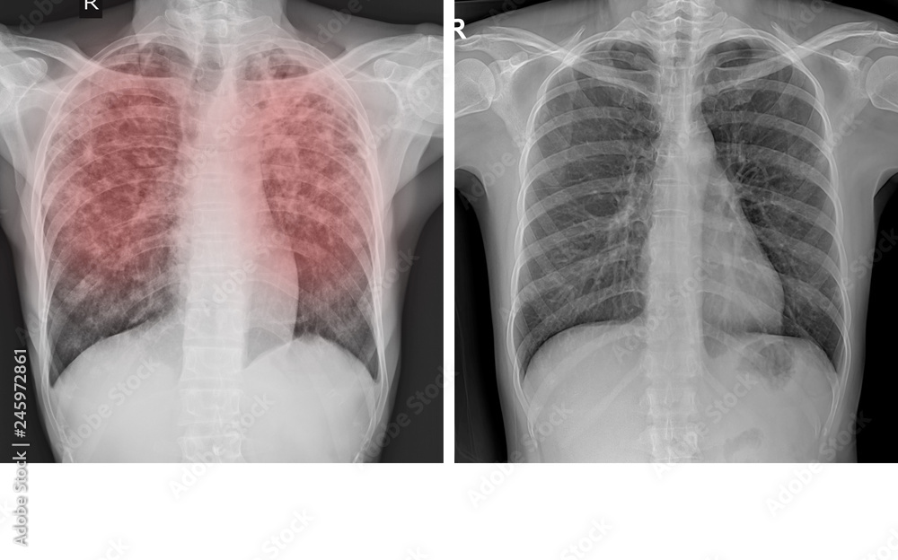 Chest xray Showing Normal chest and Pulmonary Tuberculosis ( TB ) 素材庫