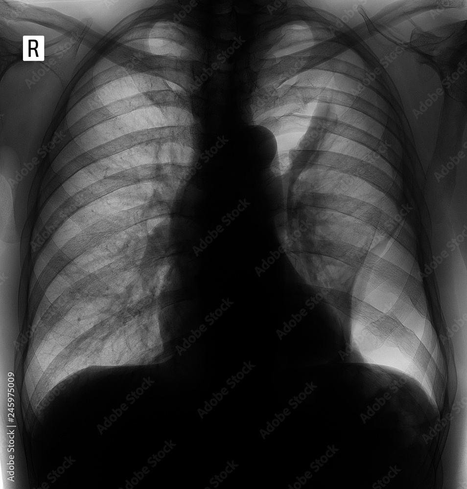 X-ray of the lungs. Post-traumatic collabated lung on the left. Rigid lung. Negative. X-ray of the lungs. Post-traumatic collabated lung on the left. Rigid lung. Negative.