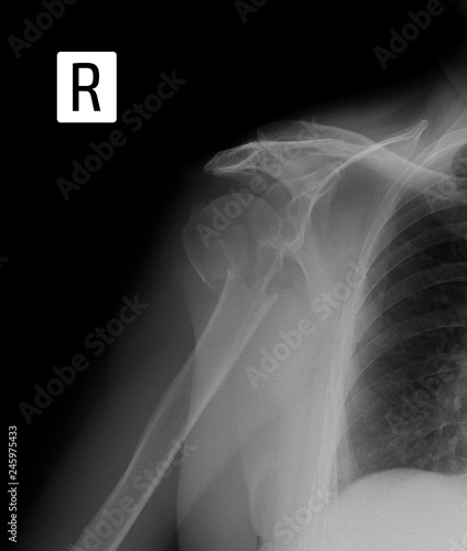 X-ray of the shoulder. Fracture-dislocated shoulder.