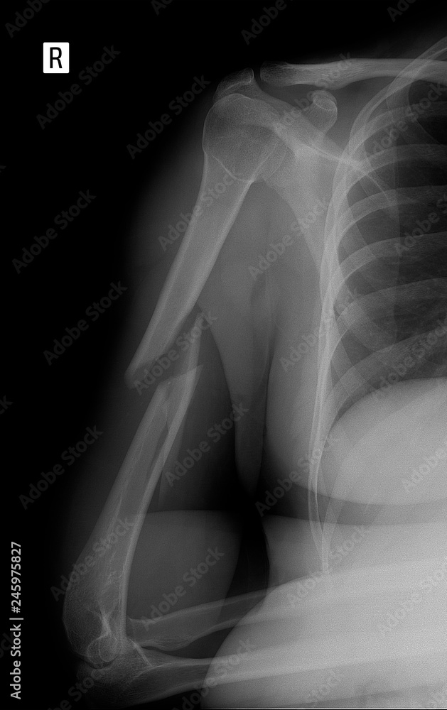 X-ray of the brachial bone. Helical humeral fracture. X-ray of the brachial bone. Helical humeral fracture.