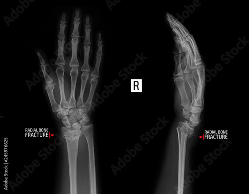X-ray of the wrist joint. Fracture of the radius. Marker. © vanzittoo