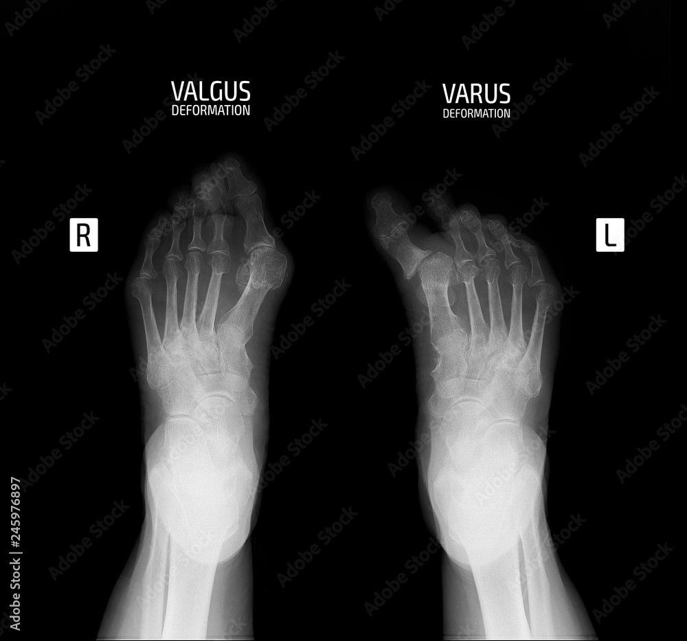 Xray of the foot. Varus and valgus deformity of the 1st finger. Stock