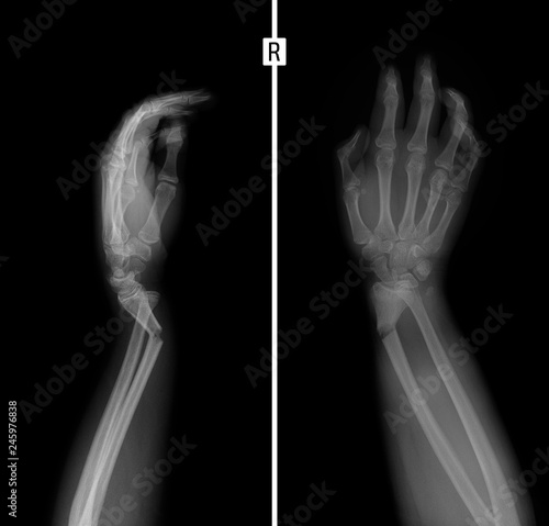 X-ray of the wrist. Greenstick fracture of the radius. 