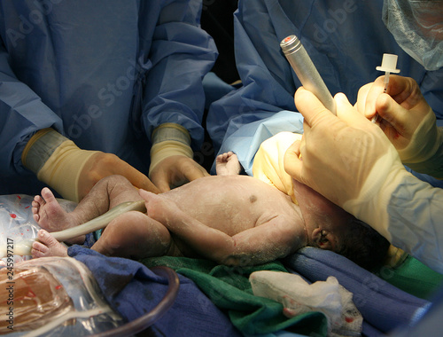 doctor intubating a newborn baby