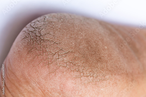 Woman' s heel break skin on white background, Close up & Macro shot, Asian skin tone