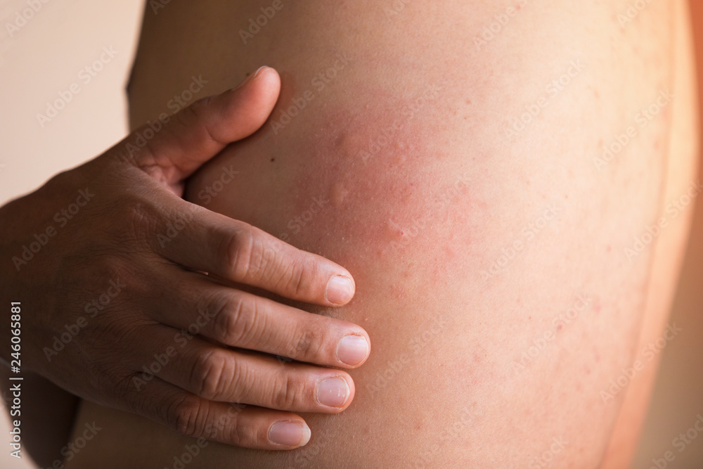 Men are scratching the skin caused by hives.,Skin rash caused by skin ...