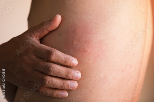 Men are scratching the skin caused by hives.,Skin rash caused by skin problems with allergic rashes, hives Man with symptoms of itchy urticaria
