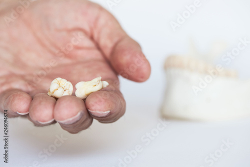 Two extracted wisdom teeth on dentist palm.