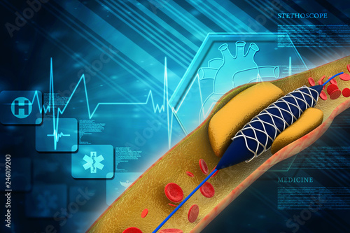 3d illustration Angioplasty with stent placement