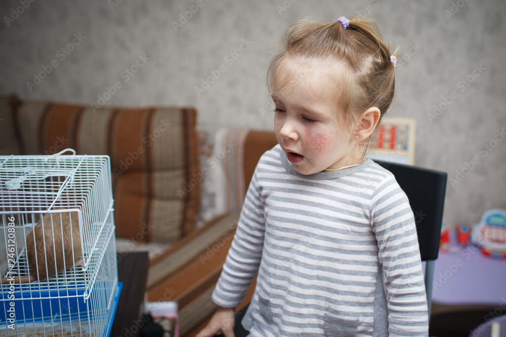 a little beautiful girl has an allergy and a rash on her cheeks due to a decorative rat. Allergies in children to pets a little beautiful girl has an allergy and a rash on her cheeks due to a decorative rat. Allergies in children to pets