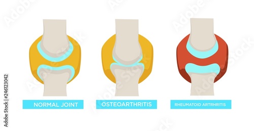 Normal joint osteoarthritis rheumatoid arthritis vector illustration