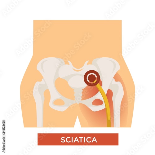 Sciatica bone disease sciatic back pain hip bone