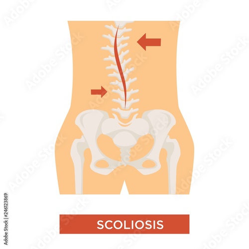 Scoliosis spine curvature skeleton bone disease vector illustration