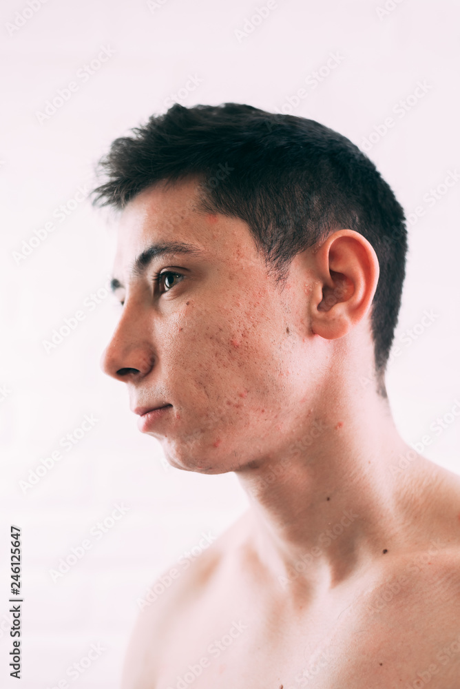 Obraz premium Man with problematic skin and scars from acne