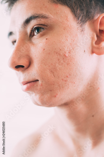 Man with problematic skin and scars from acne