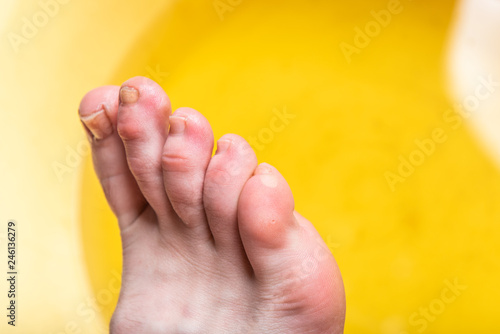 Corn or clavus on female foot. 