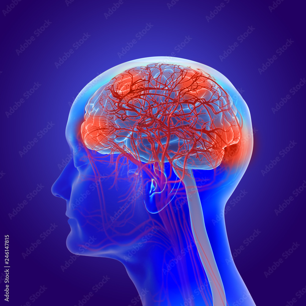 3d illustration of the human brain with alzheimer’s disease - dementia 3d illustration of the human brain with alzheimer’s disease - dementia