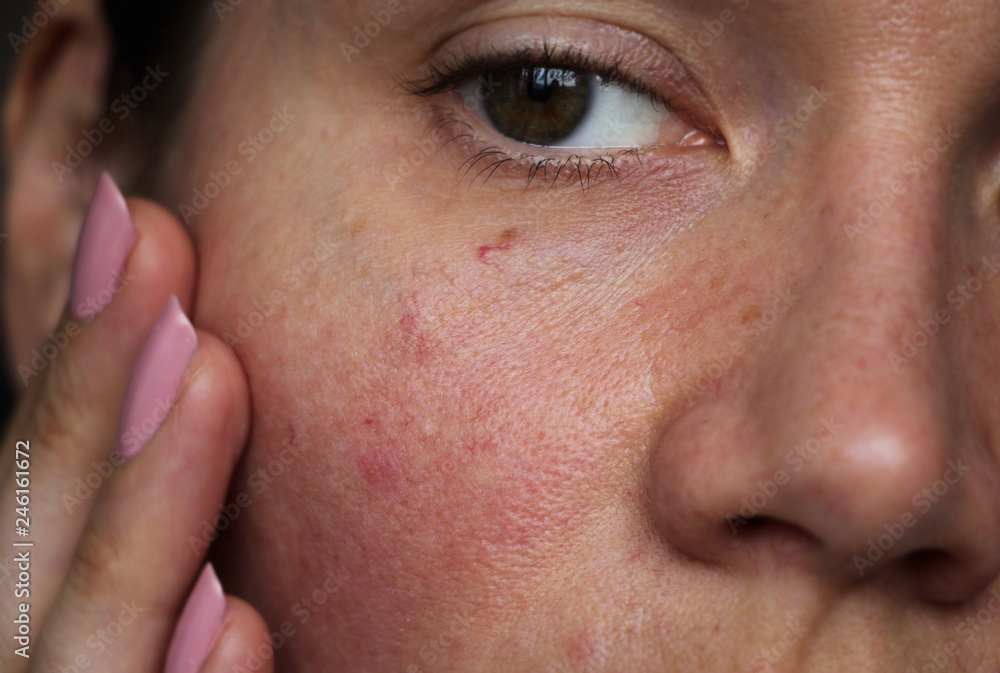 Ταπετσαρία burst capillaries on the girl's face