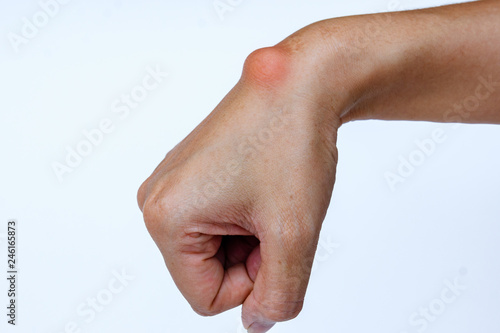 Ganglion cyst on woman hand on white background photo