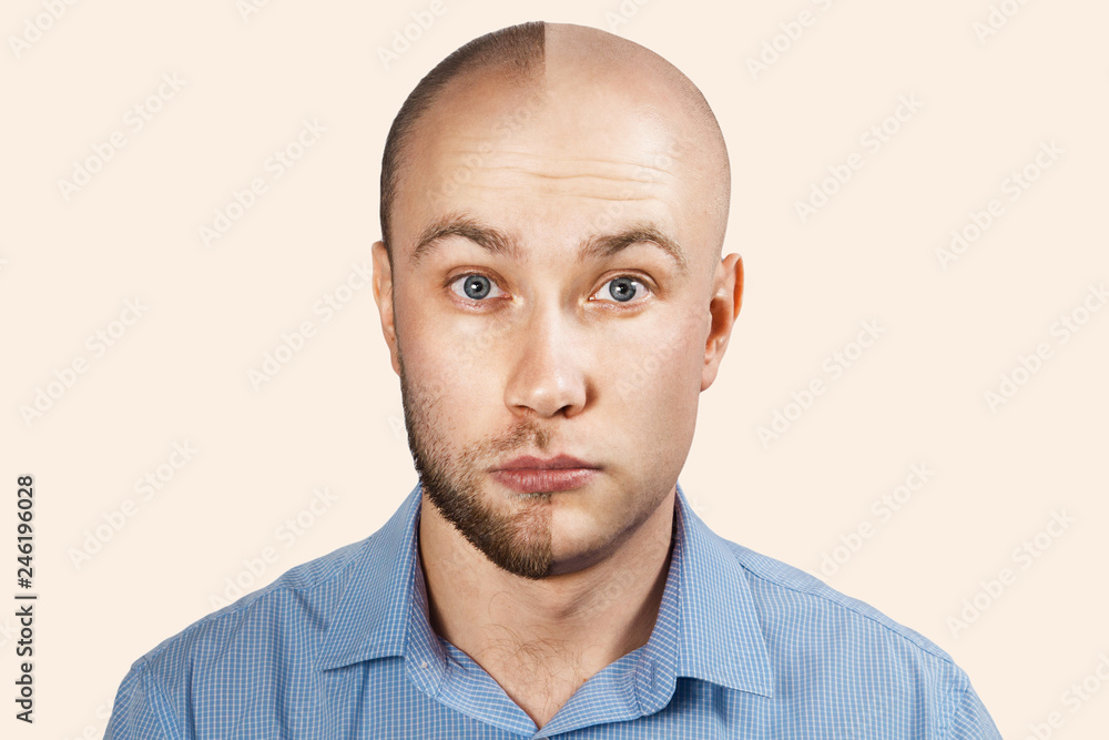 Man before and after hair loss, transplant on background Man before and after hair loss, transplant on background