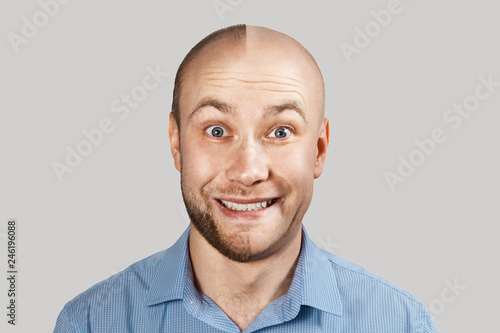 happy Man before and after hair loss, alopecia on background