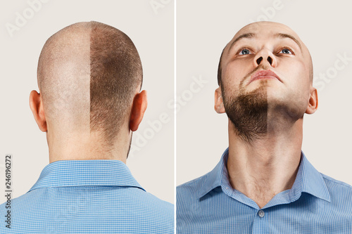 two happy Man before and after hair loss, transplant on background. concept of baldness: the first man photo in chin up, the second - behind