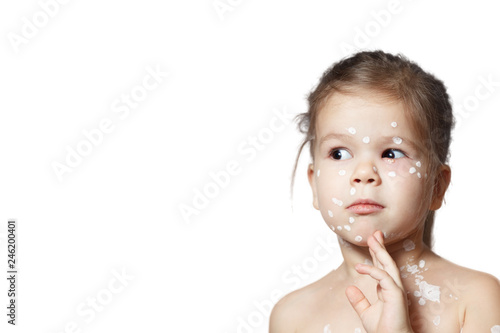 Fotografie Closeup face cute little girl with varicella virus or chickenpox bubble rash, conjunctivitis, sore eyes, red spots covered zinc lotion calamine