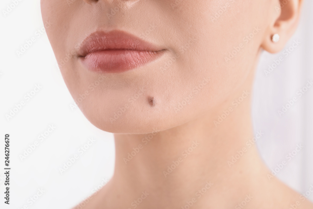 Young woman with birthmark in clinic, closeup view. Visiting dermatologist Young woman with birthmark in clinic, closeup view. Visiting dermatologist