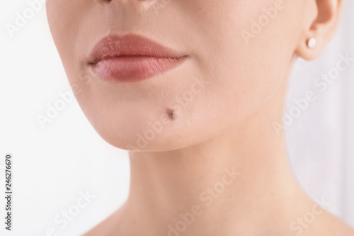 Young woman with birthmark in clinic, closeup view. Visiting dermatologist