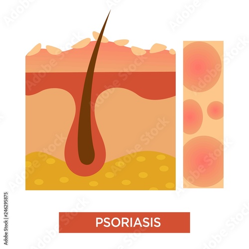 Psoriasis skin disease or illness dermatology vector illustration