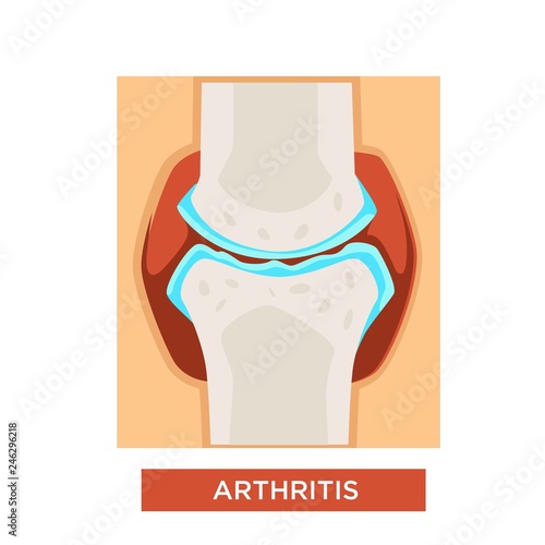 Arthritis bones or joint treatment rheumatology vector illustration