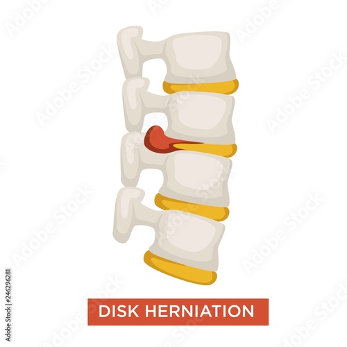 Disk herniation spine disease bone inflammation vector illustration