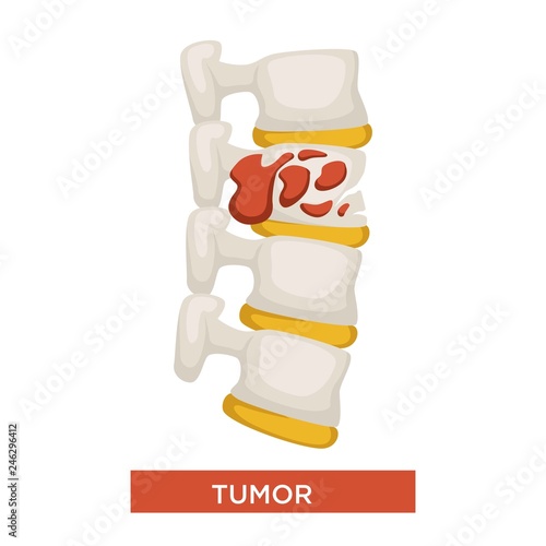 Bone tumor skeleton disease or cancer medicine