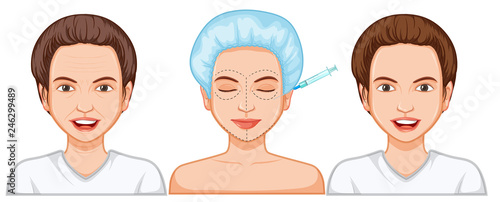Comparison of female botox injection