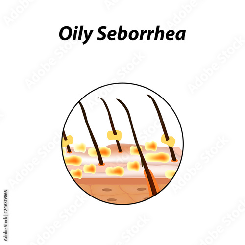 Oily seborrhea of skin and hair. Dandruff, seborrheic dermatitis. Baldness, hair growth, baldness. Anatomical structure. Infographics. Vector illustration on isolated background.