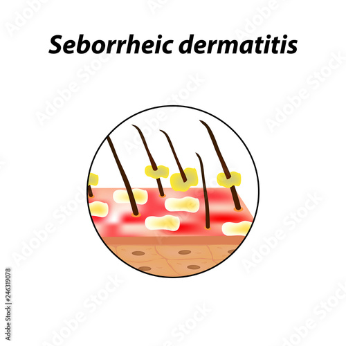 Seborrheic dermatitis of the skin and hair. Dandruff, seborrhea. Baldness, hair growth, baldness. Anatomical structure. Infographics. Vector illustration on isolated background.