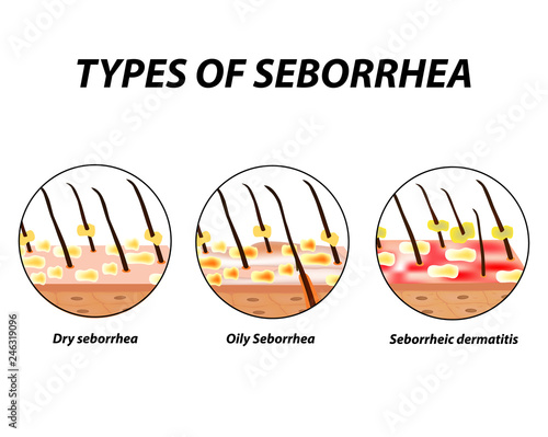 Types of seborrhea. Seborrhea skin and hair. Dandruff, seborrheic dermatitis. Baldness, hair growth, baldness. Anatomical structure. Infographics. Vector illustration on isolated background.