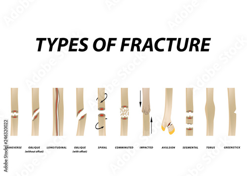 Types of fracture. Fracture bone set. Infographics. Vector illustration on a lined background.