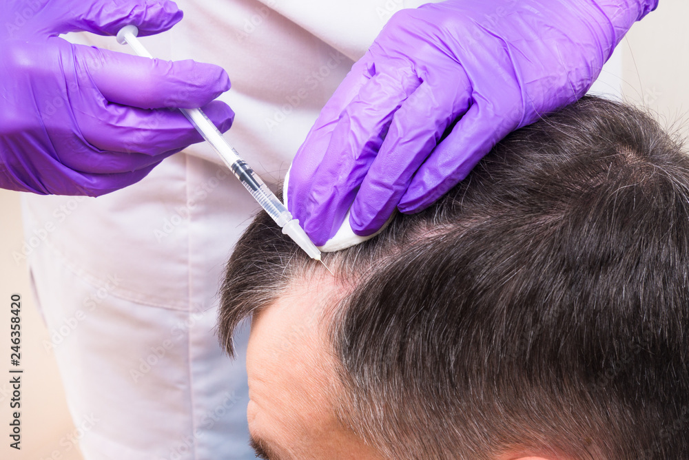 Injection, Treatment for Hair Loss StockFoto Adobe Stock