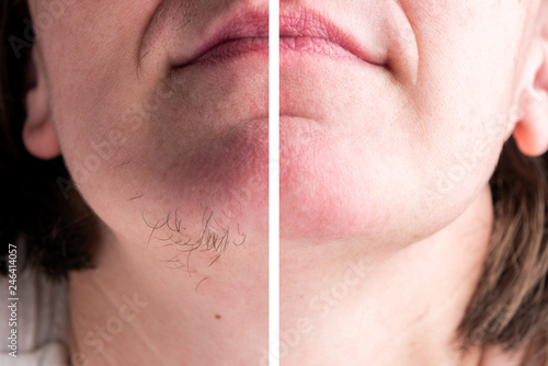 Slika na platnu Woman with hairs on chin. Hair removal on face.