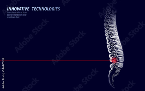 Laser physiotherapy human spine injury. Pain area surgery operation modern loin medicine technology low poly triangles 3D render female back hernia vector illustration