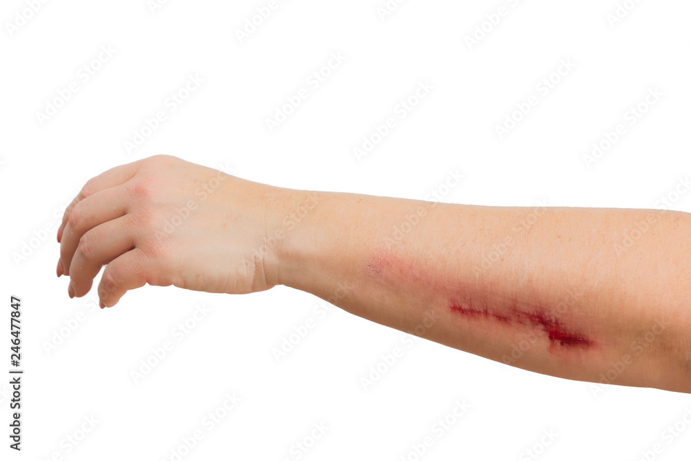 abrasion on a womans arm abrasion on a womans arm