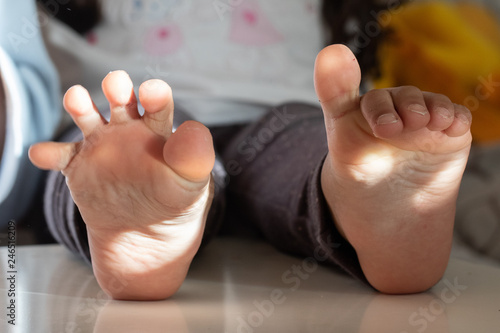 Big toe varism in the feet of a child photo
