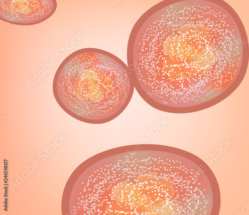 Vulgar psoriasis. Not pustular type psoriasis texture. Eczema, skin disease dermatitis. Infographics. Vector illustration.