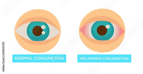 Normal and inflamed conjunctiva sore eye disease