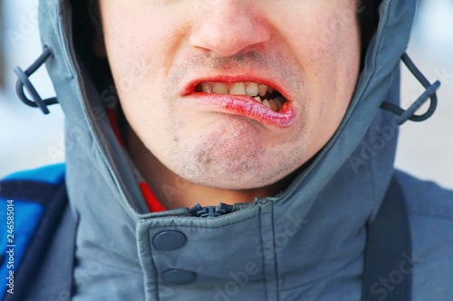 Cracked dry lips of man's face. The man's face contorts in pain dry mouth and skin. Care for chapped lips in the cold season. Concept of a healthy lifestyle. photo