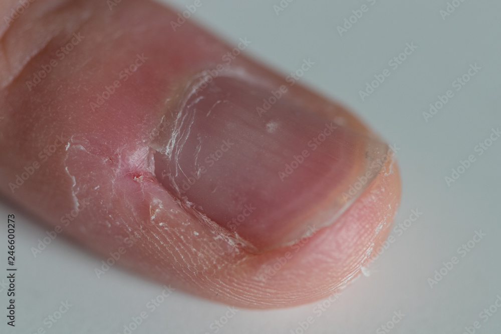 Closeup of a nail surrounded by fissures on a white background. The pinky finger was compulsively bitten due to nervousness Closeup of a nail surrounded by fissures on a white background. The pinky finger was compulsively bitten due to nervousness