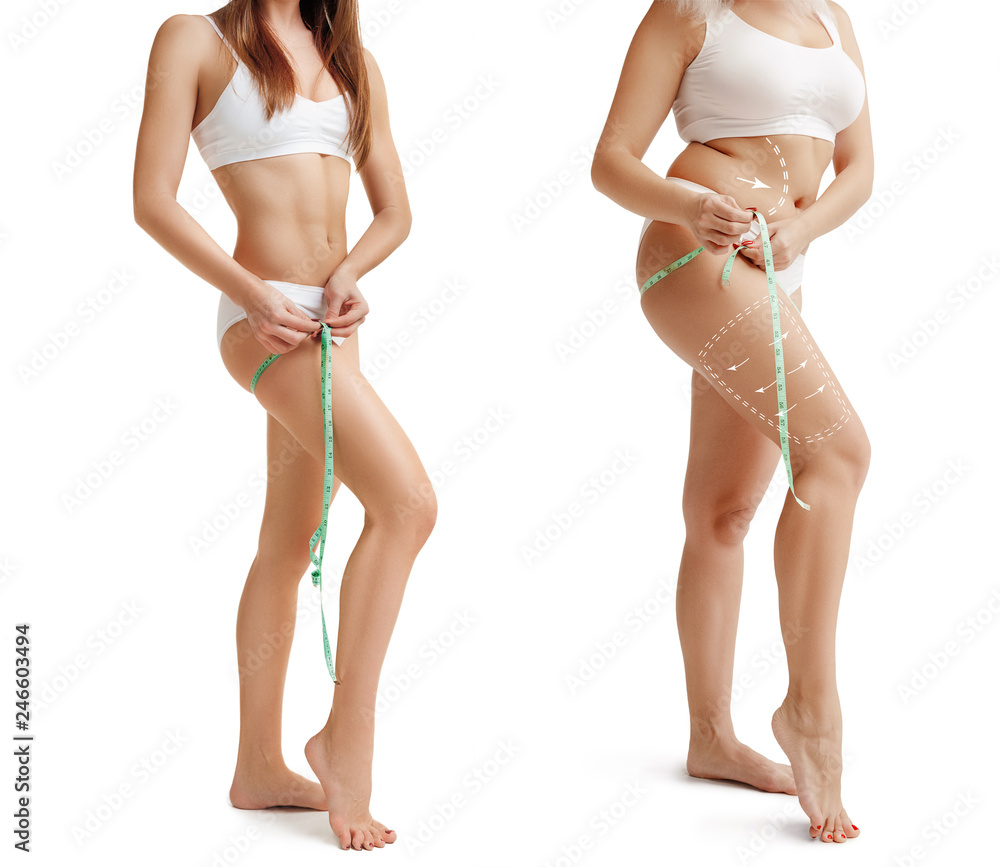 Two young thick and thin women have different figures. Comparison concept.  Slim and fat girls. Fat lose, liposuction and cellulite removal concept.  Marks on the woman before plastic surgery. Image is Stock