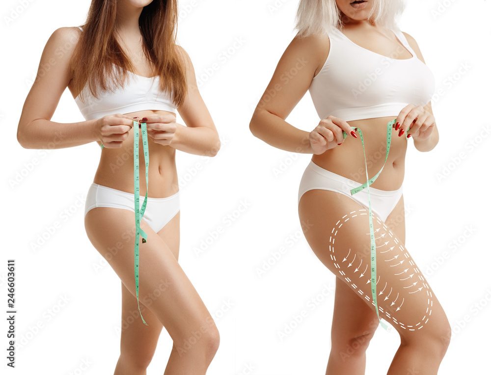 Two young thick and thin women have different figures. Comparison concept. Slim and fat girls. Fat lose, liposuction and cellulite removal concept. Marks on the woman before plastic surgery. Image is - obrazy, fototapety, plakaty 